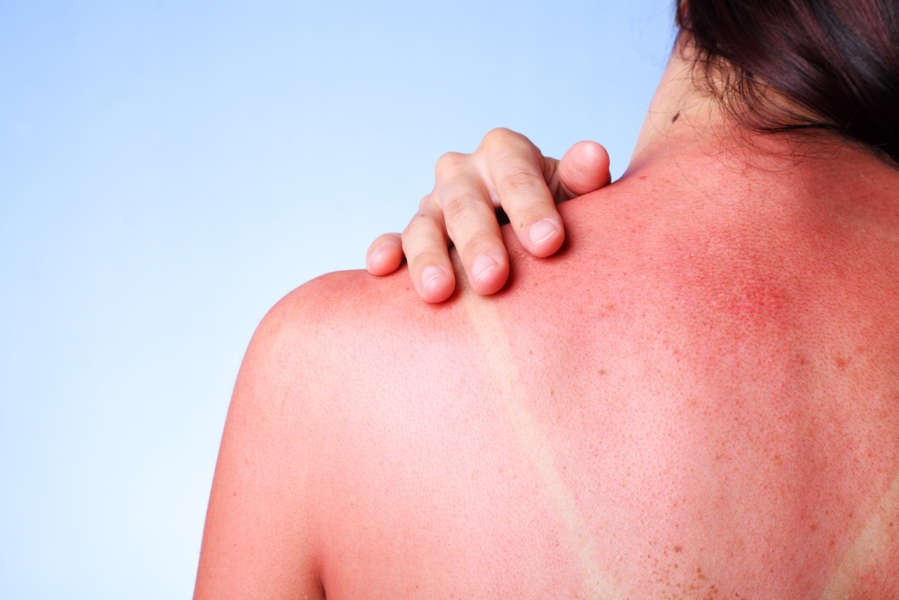 Os melhores superalimentos para proteger a sua pele do sol